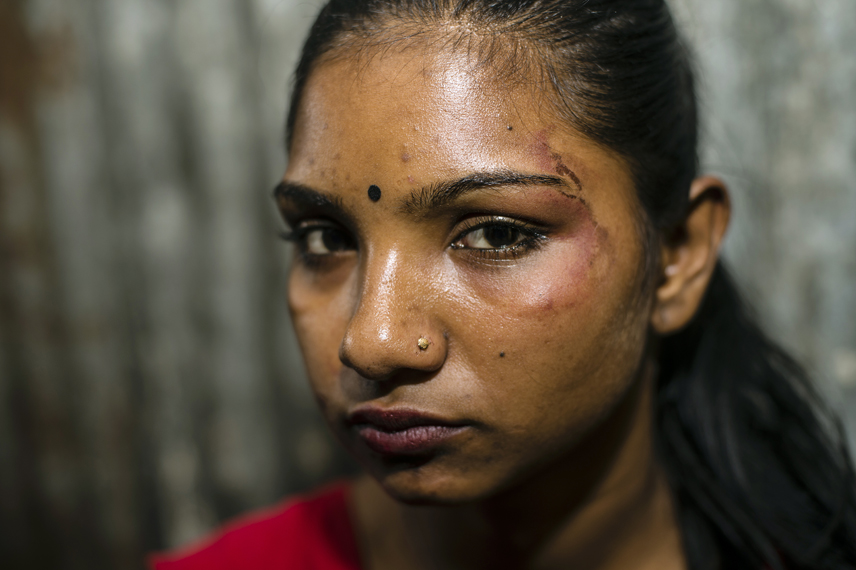Sumaiya, 17, in the Kandapara brothel in Tangail. Her boyfriend and regular customer Titu, 23, has beaten her in the face. He is from Dhaka and visits ger every month one week. They are often fighting, because Tutu wants to marry her, but she doesn«t want. She is afraid that after marriage he will take away all her money. He is jealous, because she has sex with many of his friends. Sumaiya is jealous because he has sex with other sexworkers in the brothel.